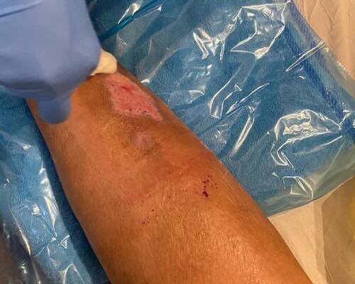 Wound Care - Home Care - Private Nursing